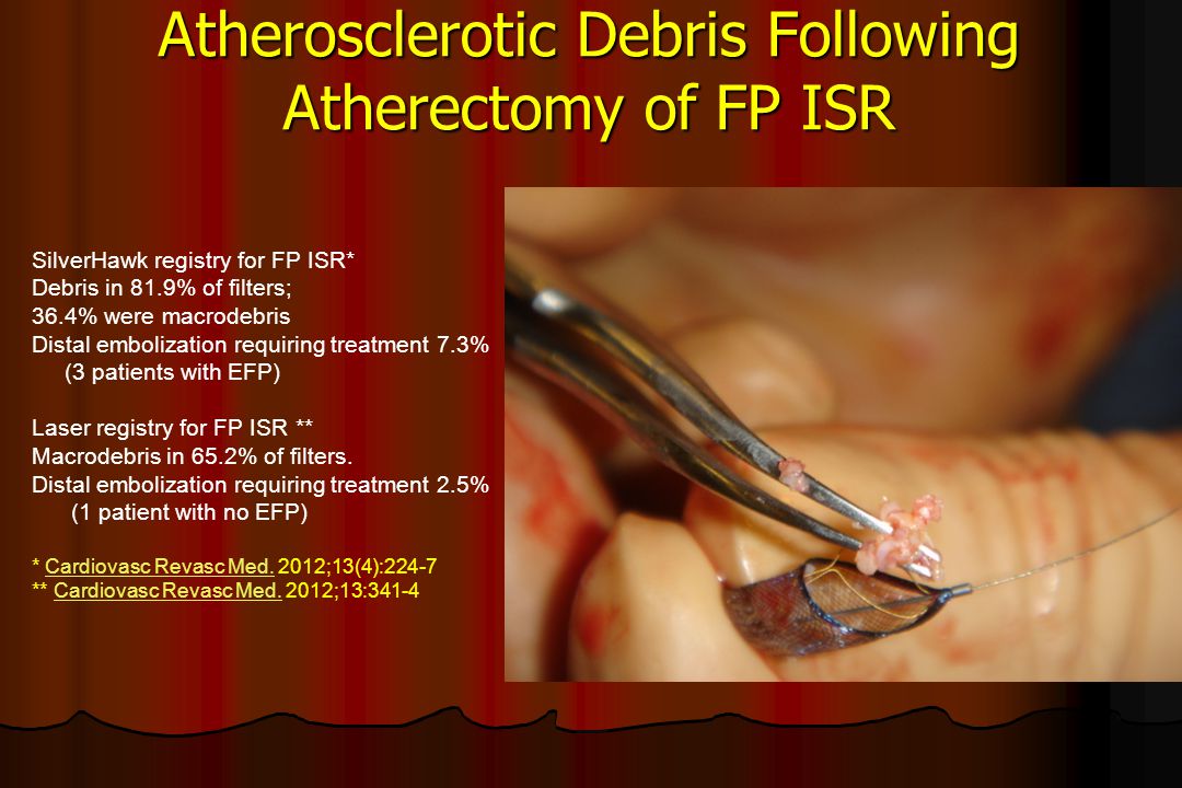 Atherosclerotic Debris Following Atherectomy of FP ISR
