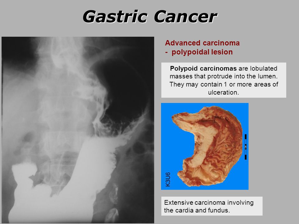 Gastric Cancer Ppt Video Online Download