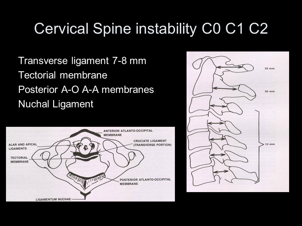 Surgery For Cervical Spine Disease Ppt Video Online Download