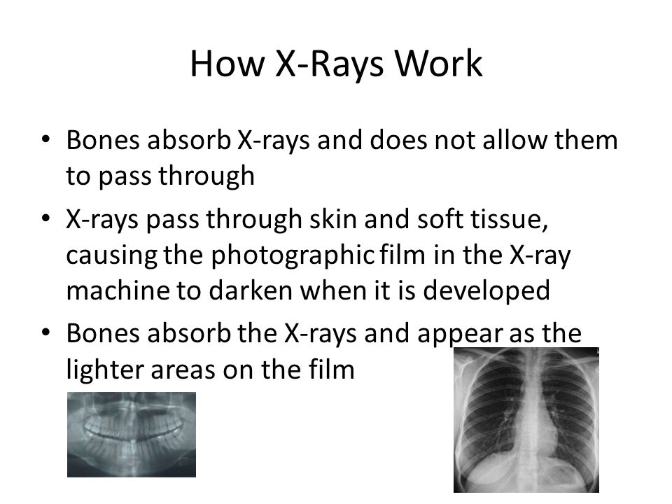 How X-Rays Work Bones absorb X-rays and does not allow them to pass through.