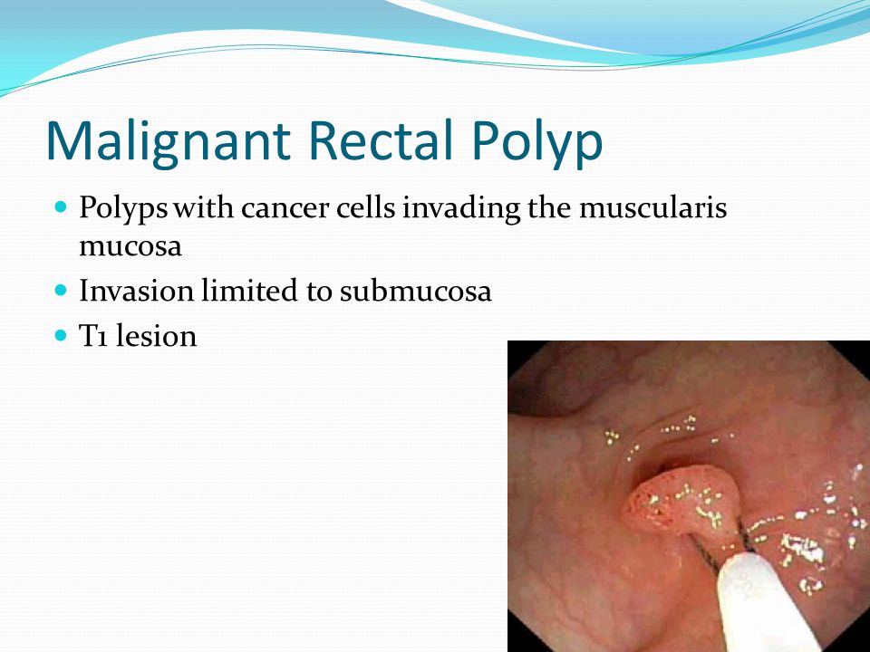 rectal polypectomy