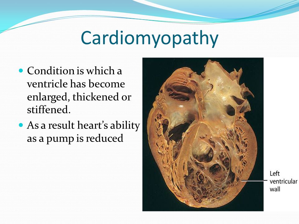 Cardiomyopathy Condition is which a ventricle has become enlarged, thickened or stiffened.
