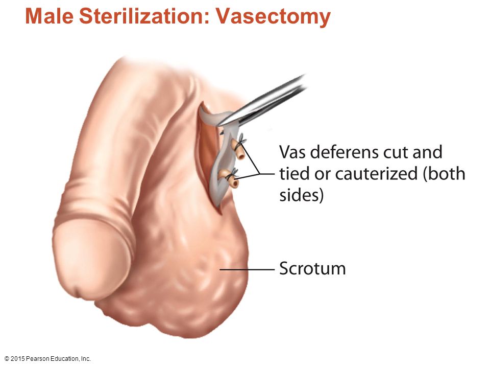 Male Sterilization: Vasectomy.
