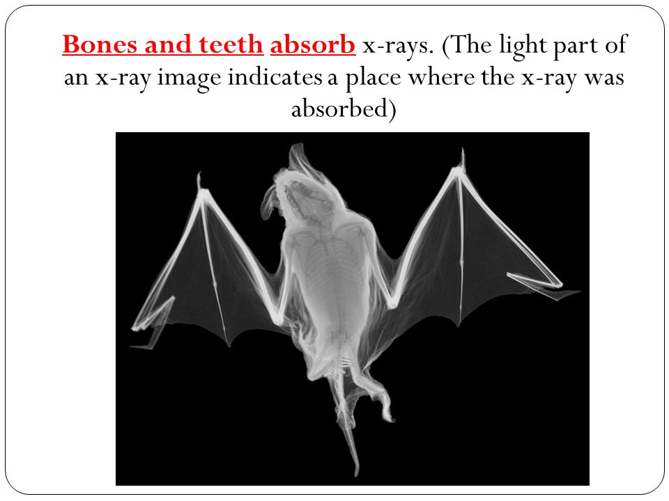 Bones and teeth absorb x-rays