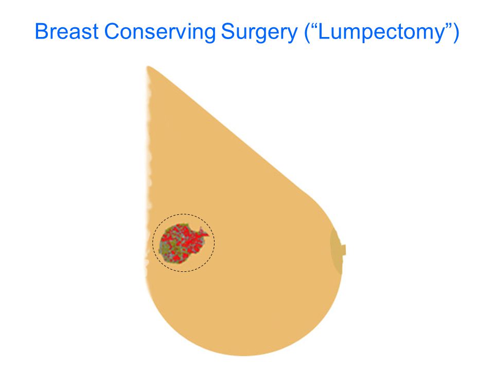 Breast Conserving Surgery ( Lumpectomy )