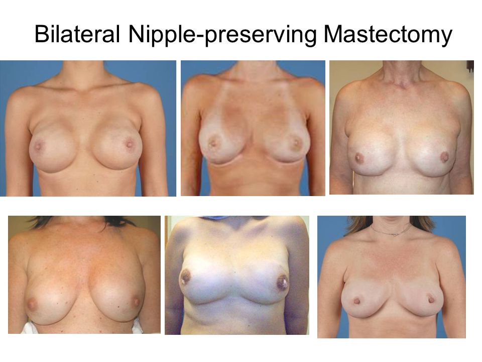 Bilateral Nipple-preserving Mastectomy
