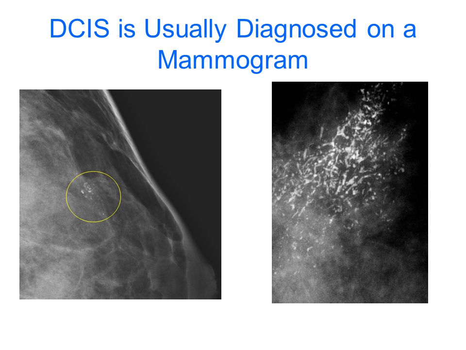 DCIS is Usually Diagnosed on a Mammogram