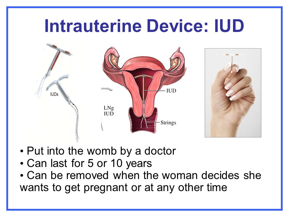 Intrauterine Device: IUD