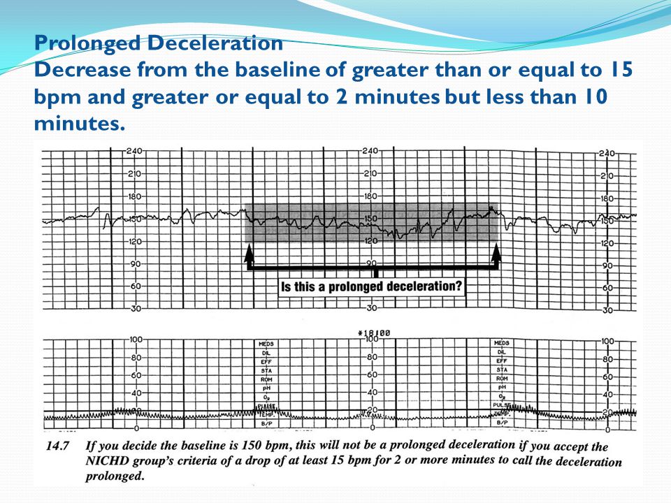 Prolonged Deceleration Decrease from the baseline of greater than or equal to 15 bpm and greater or equal to 2 minutes but less than 10 minutes.