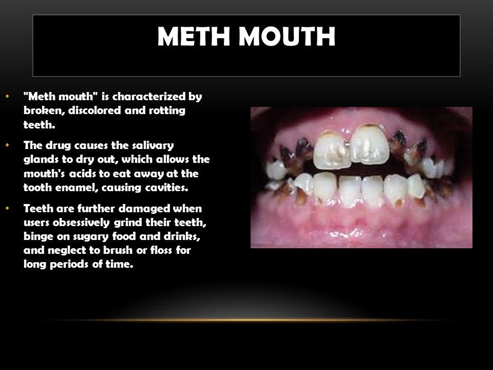 Meth Mouth Meth mouth is characterized by broken, discolored and rotting te...