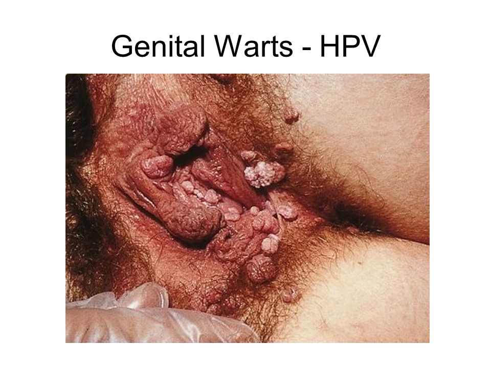 Genital Warts - HPV.
