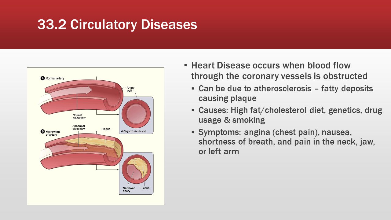 33.2 Circulatory Diseases Heart Disease occurs when blood flow through the coronary vessels is obstructed.