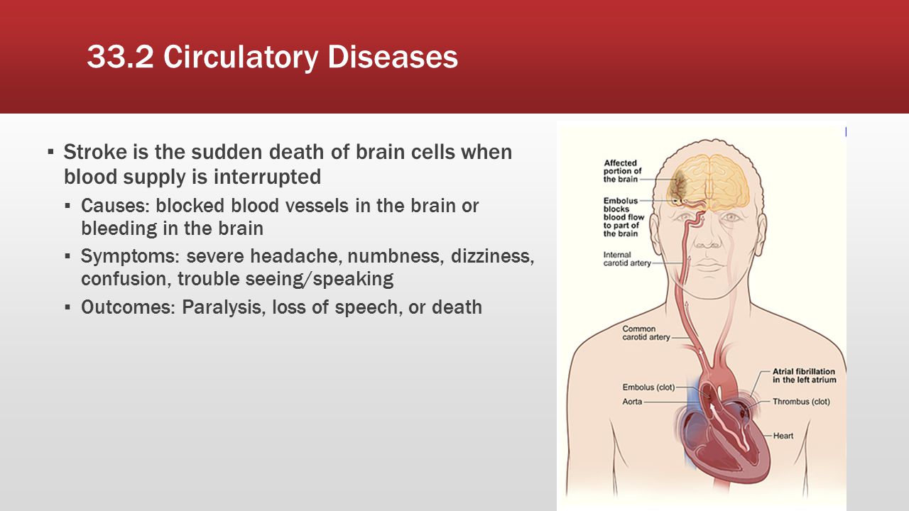33.2 Circulatory Diseases Stroke is the sudden death of brain cells when blood supply is interrupted.
