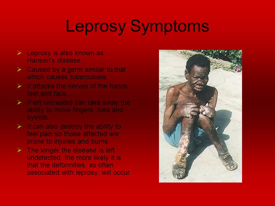 Leprosy Mycobacterium Leprae Ppt Video Online Download
