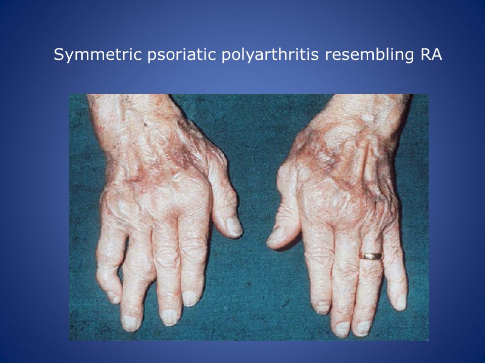 Polyarthritis arthrosis akik kezelik. Ízületi gyulladása van? Így segíthet az akupunktúra