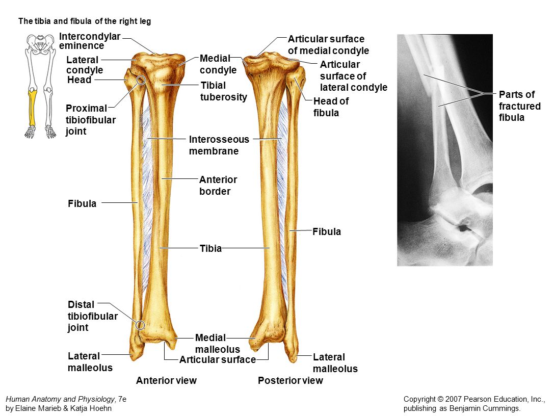 The tibia and fibula of the right leg.