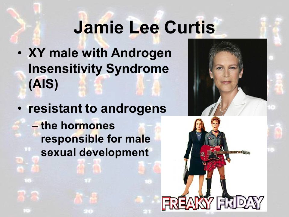 Jamie Lee Curtis XY male with Androgen Insensitivity Syndrome (AIS) .
