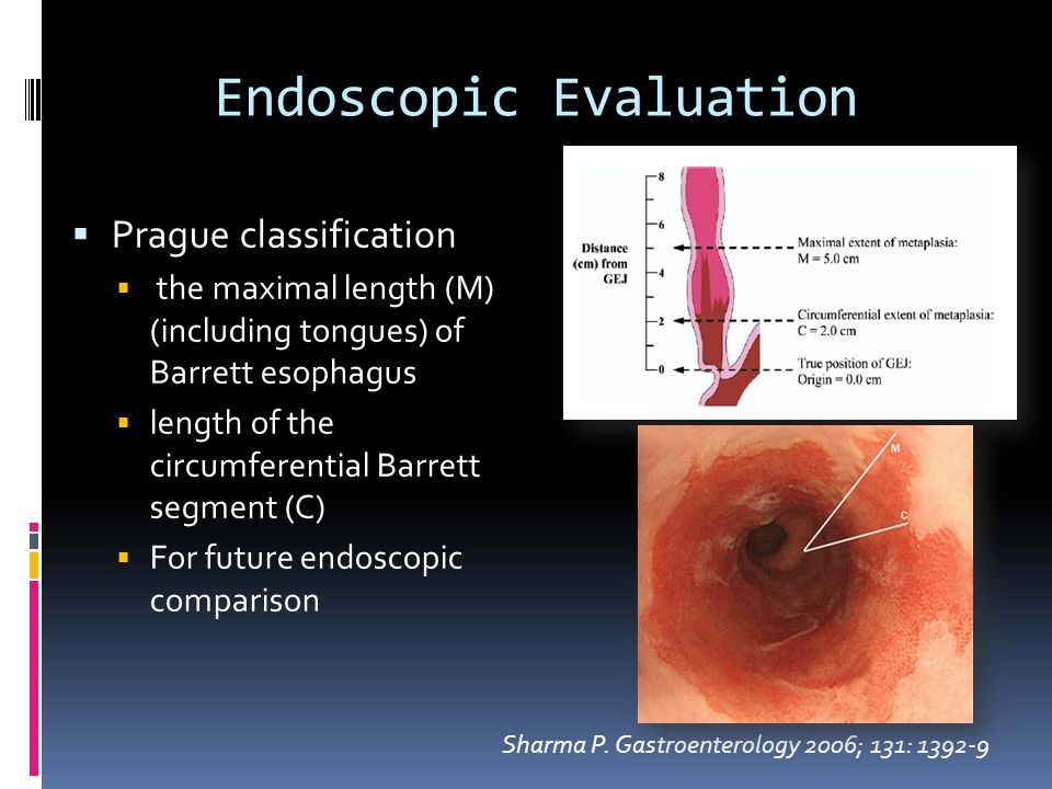 Management of Barrett's oEsophagus - ppt video online download