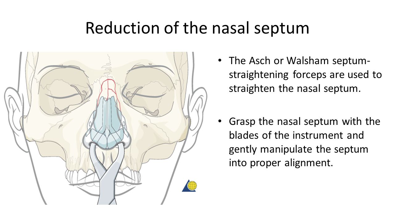 Management Of Fracture Of The Nasal Bones Ppt Video Online Download