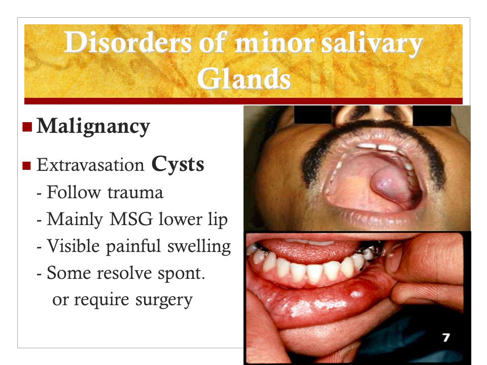 Salivary Glands Disorders Ppt Video Online Download