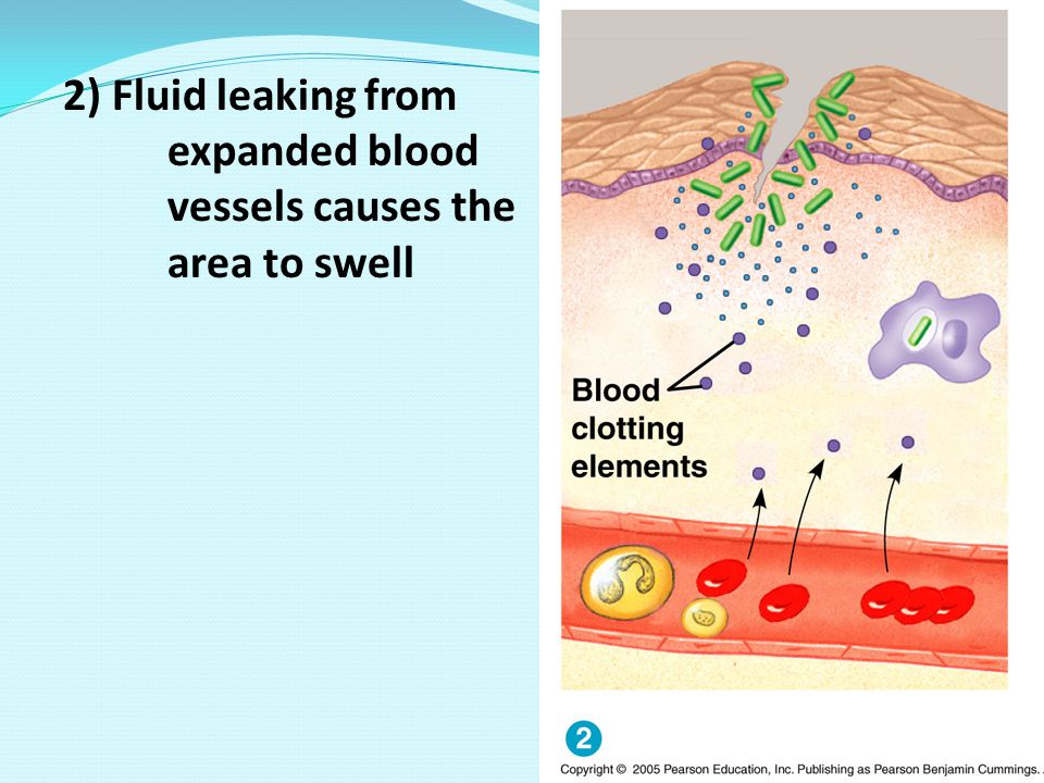 2) Fluid leaking from expanded blood vessels causes the area to swell