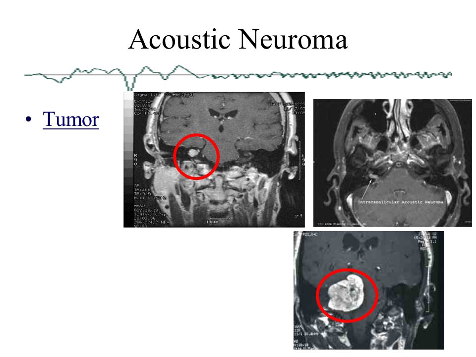 Acoustic Neuroma Tumor