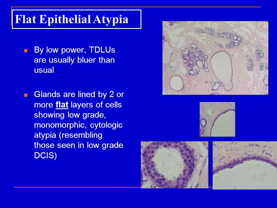 Proliferative Epithelial lesions of the Breast - ppt video online download