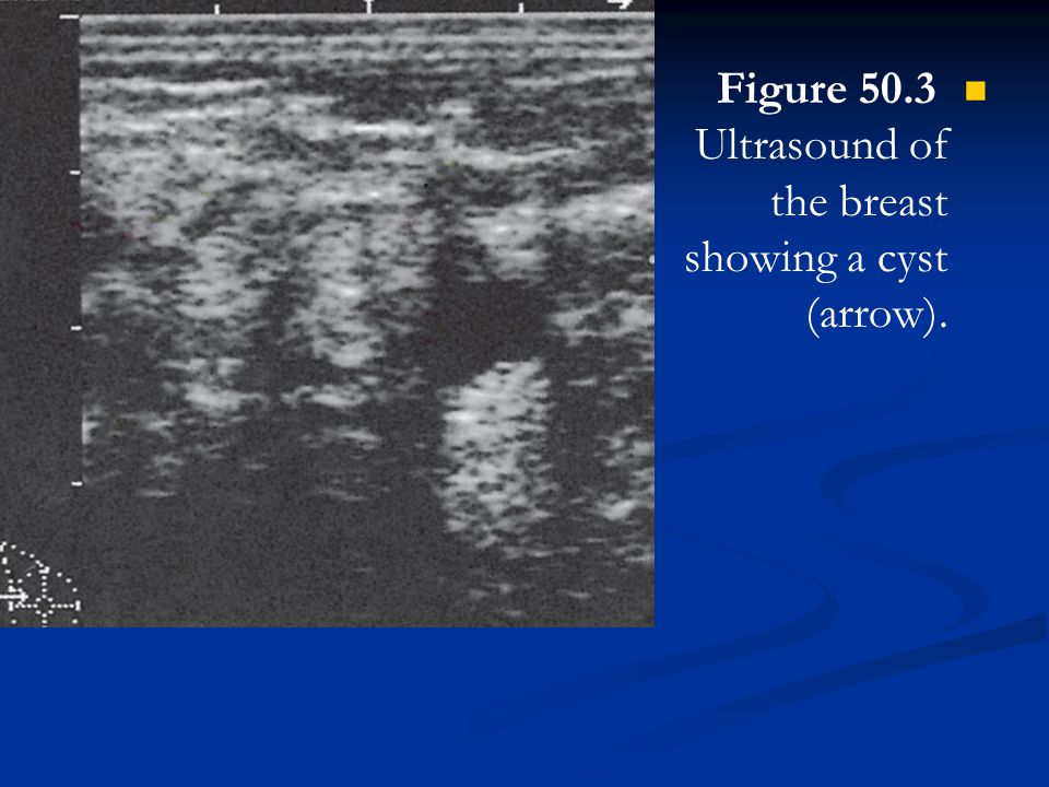 Figure 50.3 Ultrasound of the breast showing a cyst (arrow).