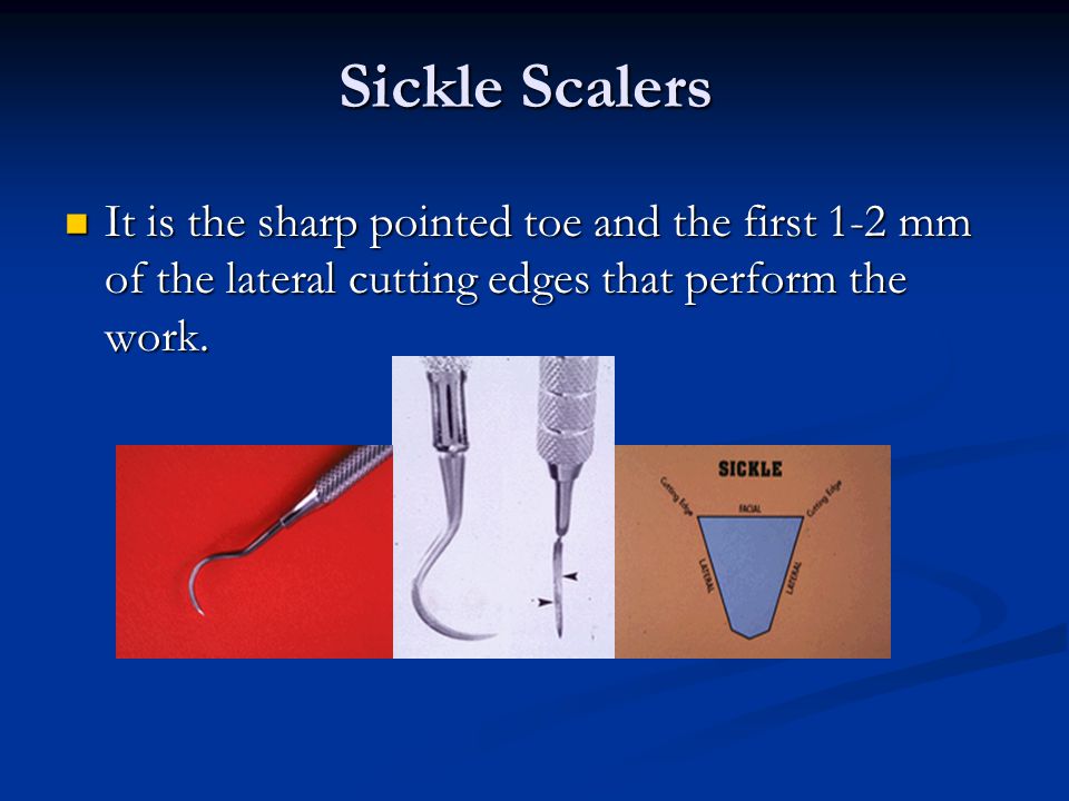 Sickle Scalers It is the sharp pointed toe and the first 1-2 mm of the lateral cutting edges that perform the work.