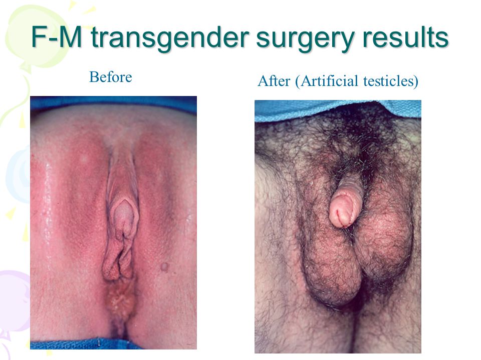 F-M transgender surgery results.