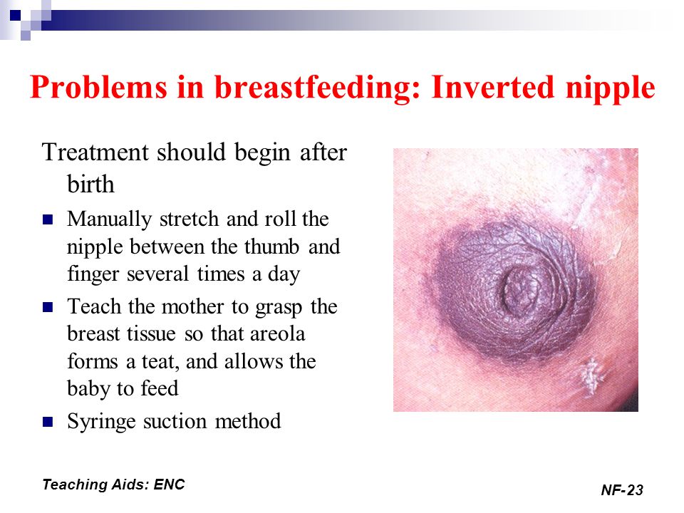 A Quick Breast Revision Procedure Can Correct Inverted Nipples