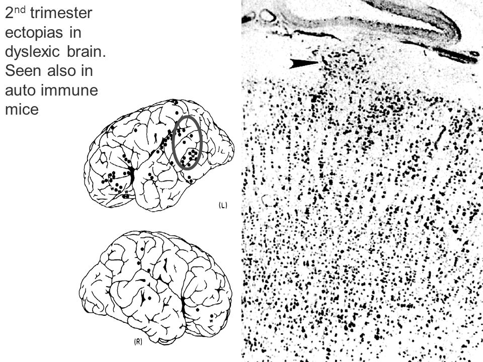 2nd trimester ectopias in dyslexic brain. Seen also in auto immune mice