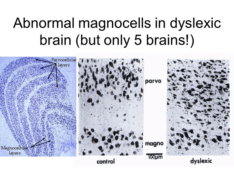 Abnormal magnocells in dyslexic brain (but only 5 brains!)