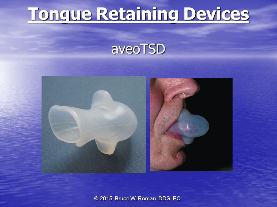 Tongue Retaining Device For Mild Sleep Apnea