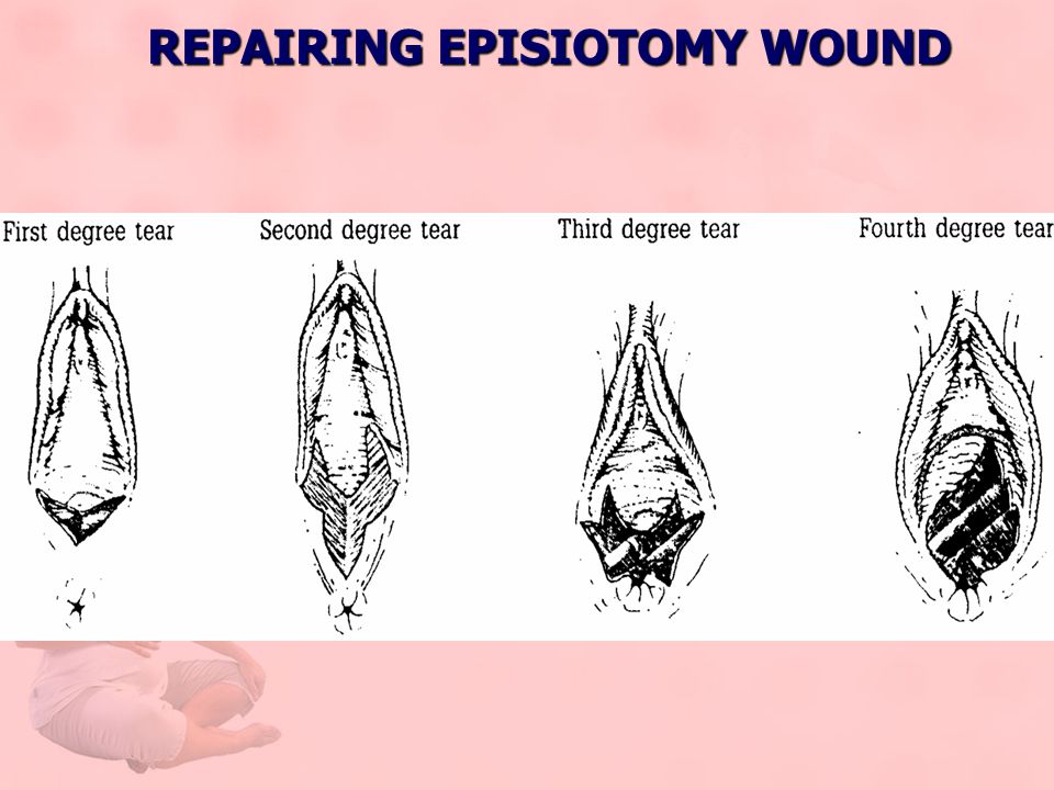 Эпизиотомия. Как делается эпизиотомия. Латеральная эпизиотомия.