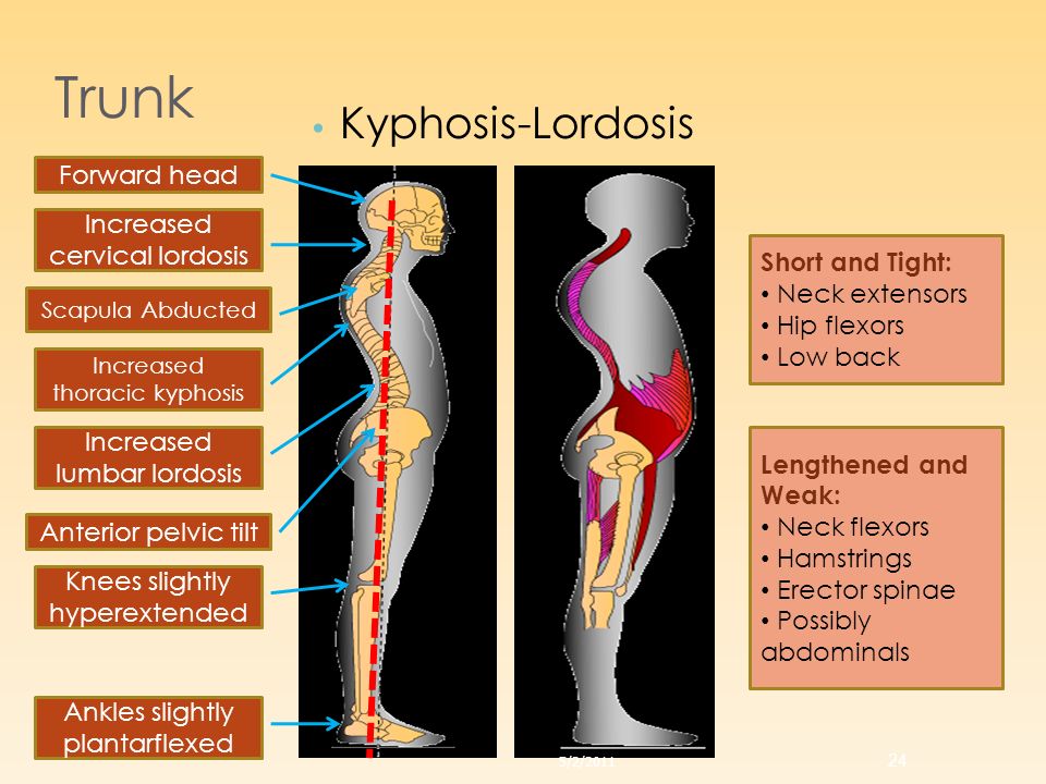 5/2/2011. Increased lumbar lordosis. 