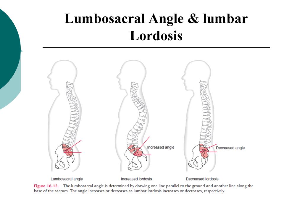 Lumbosacral Angle & lumbar Lordosis.