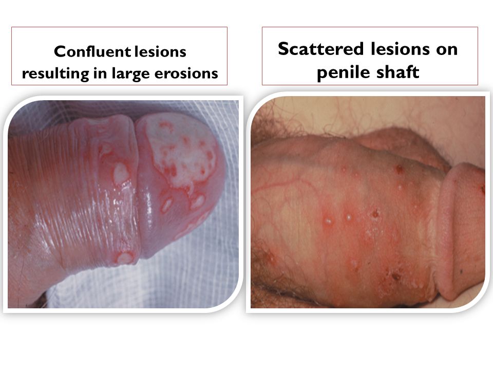 resulting in large erosions Scattered lesions on penile shaft.