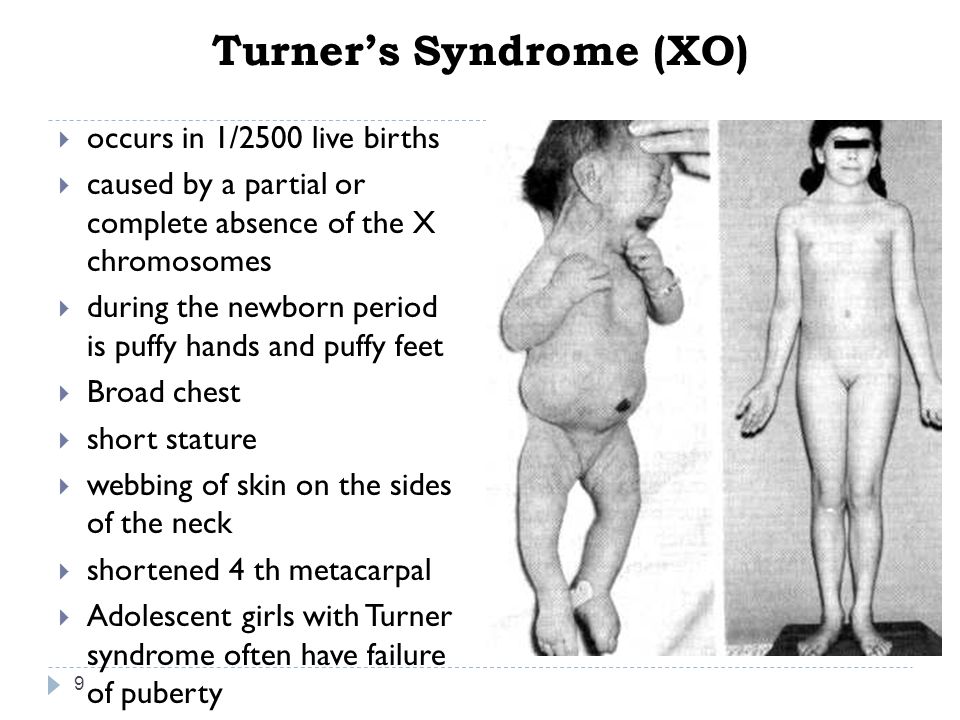 Turner’s Syndrome (XO) .
