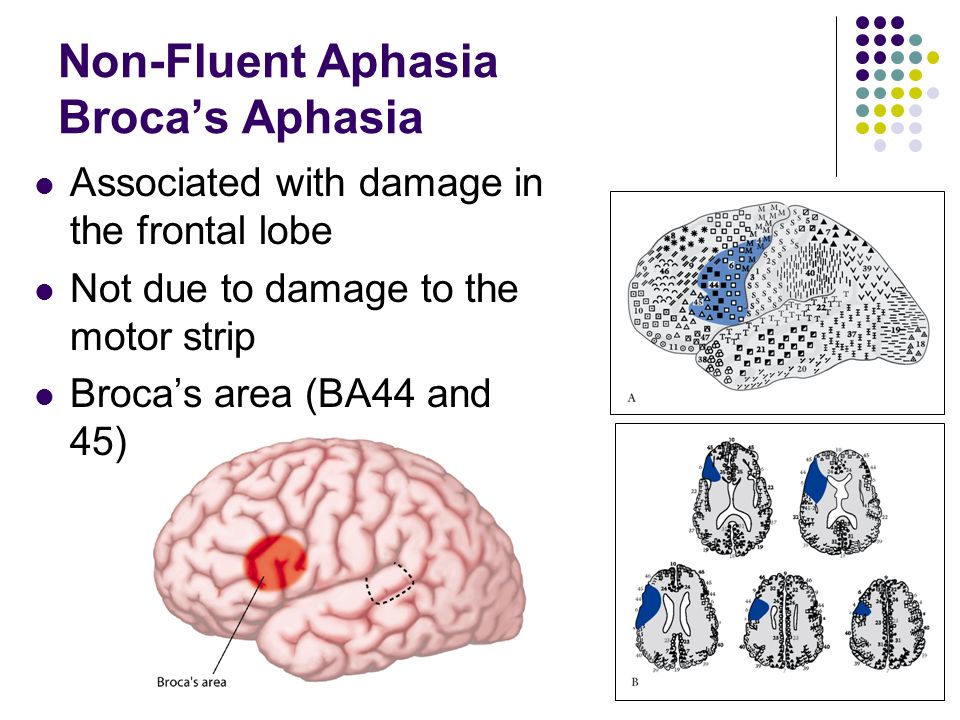 Этиология афазии. Broca's Aphasia. Fluent Aphasia. Эмбер афазия. Motor Aphasia.