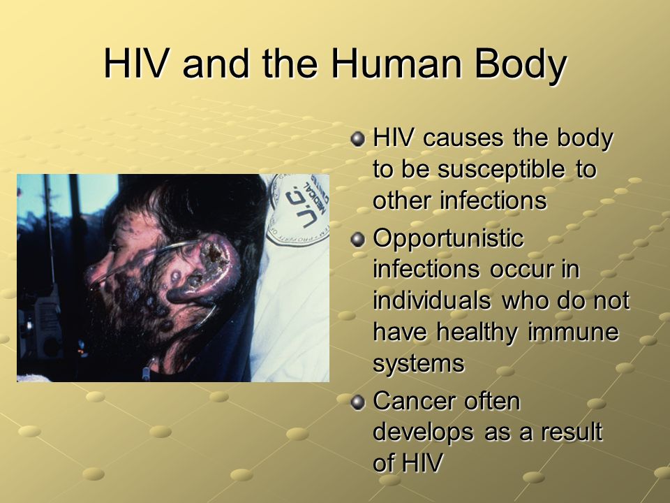 HIV and the Human Body HIV causes the body to be susceptible to other infections.