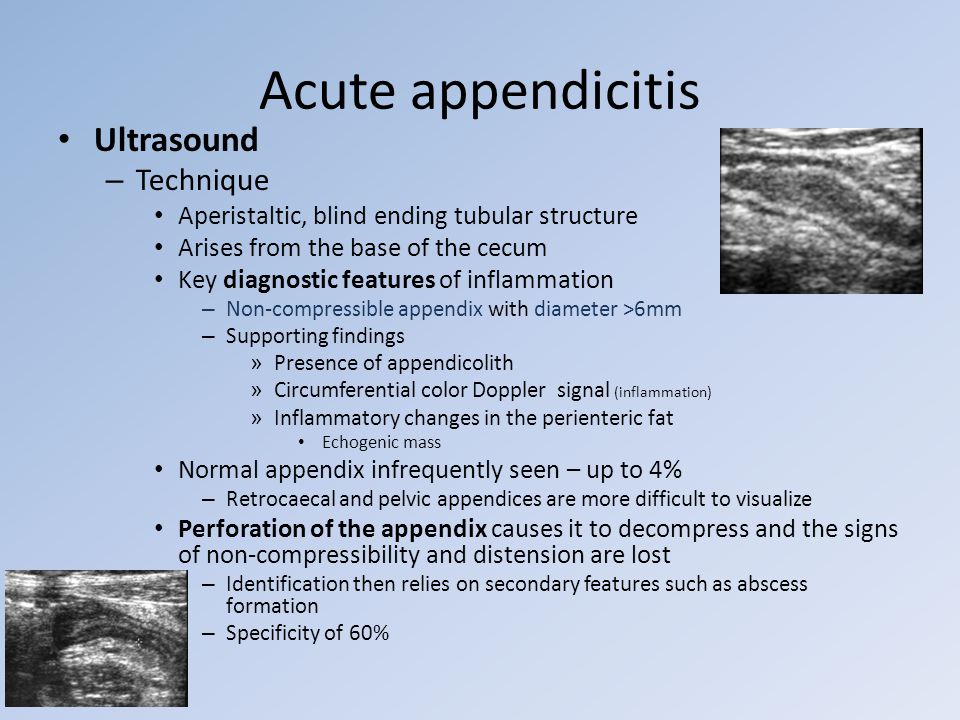 Acute appendicitis Ultrasound Technique 