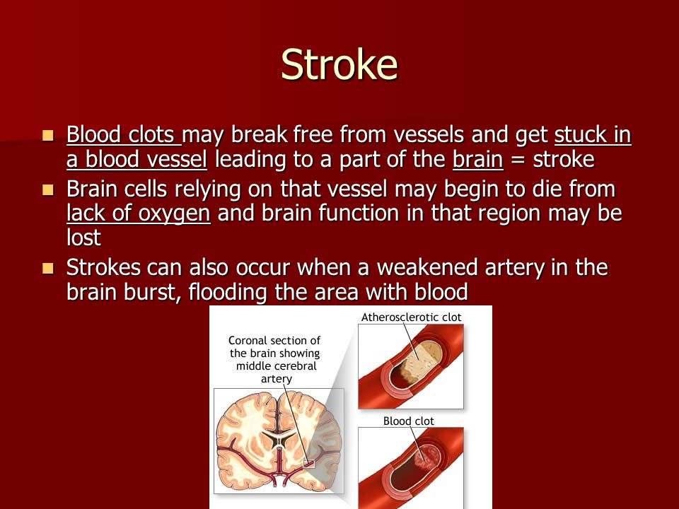 Stroke Blood clots may break free from vessels and get stuck in a blood vessel leading to a part of the brain = stroke.
