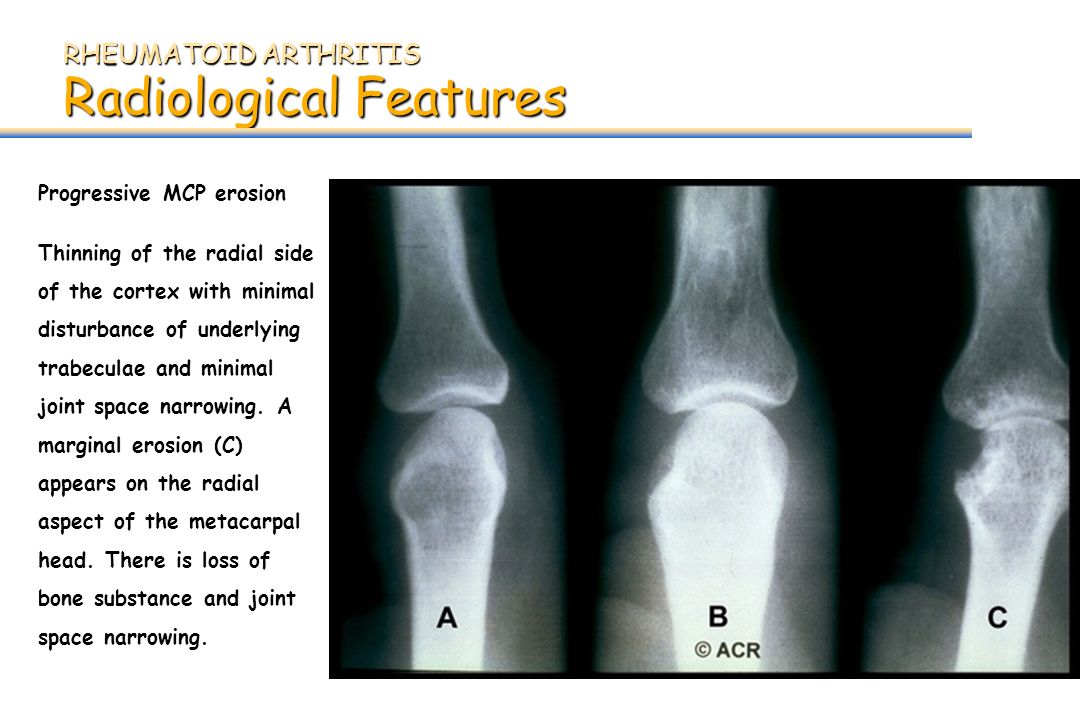 rheumatoid arthritis radiology ppt