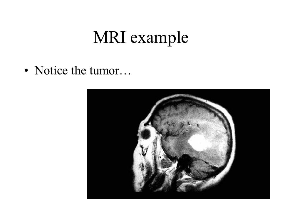MRI example Notice the tumor…
