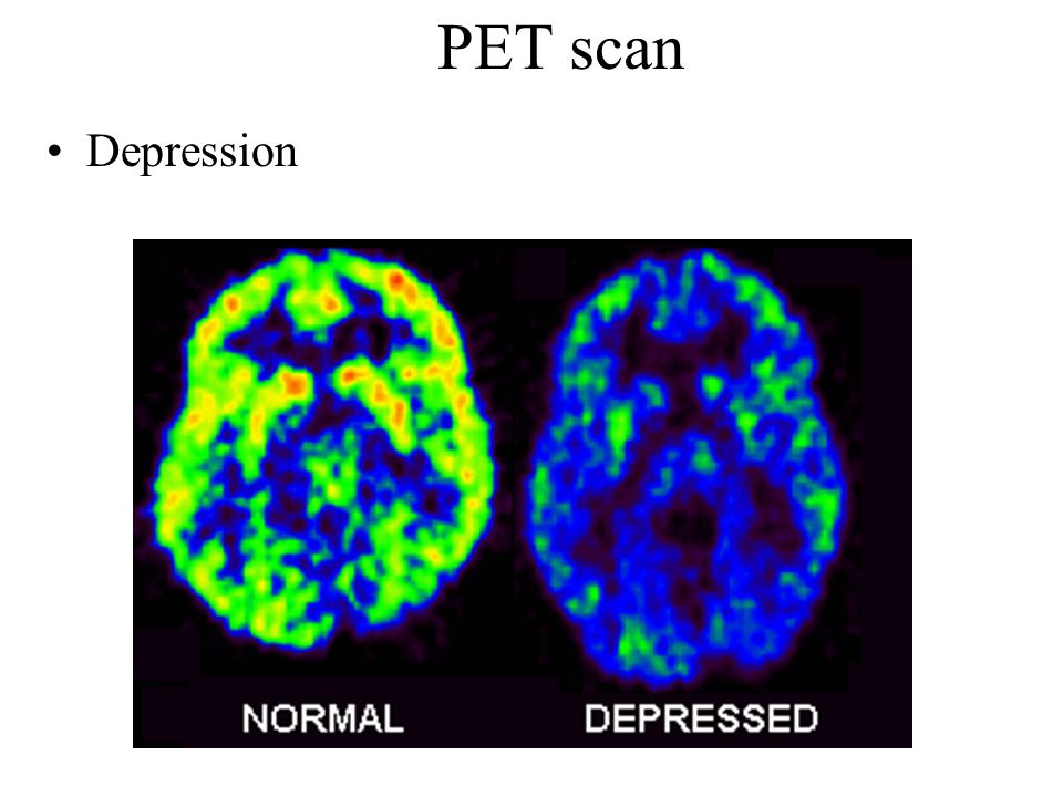 PET scan Depression