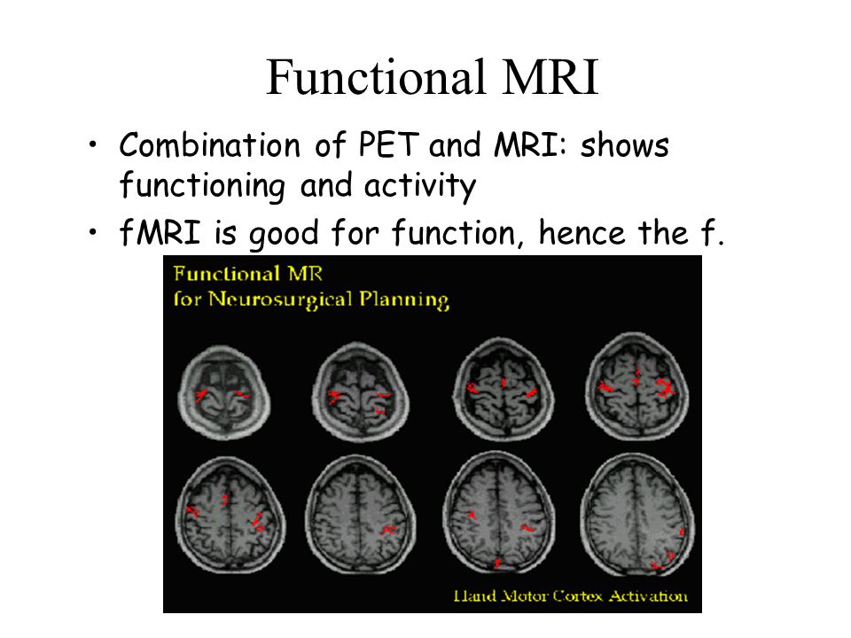 Functional MRI Combination of PET and MRI: shows functioning and activity.
