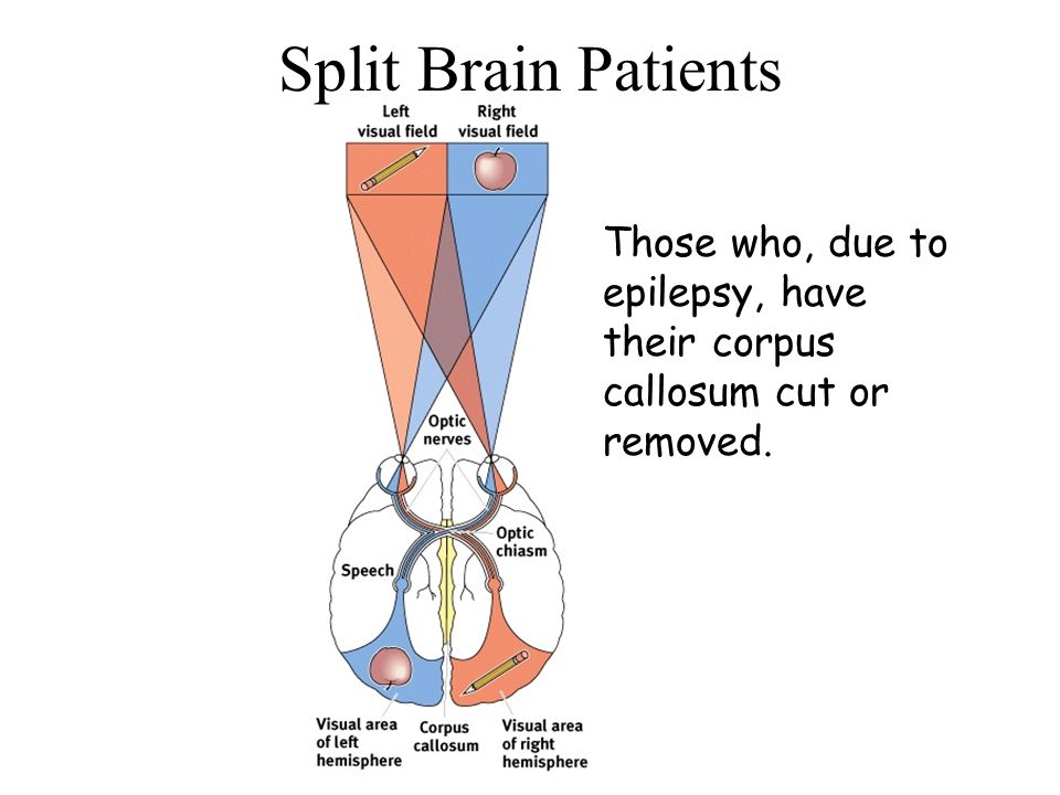 Split Brain Patients Those who, due to epilepsy, have their corpus callosum cut or removed.