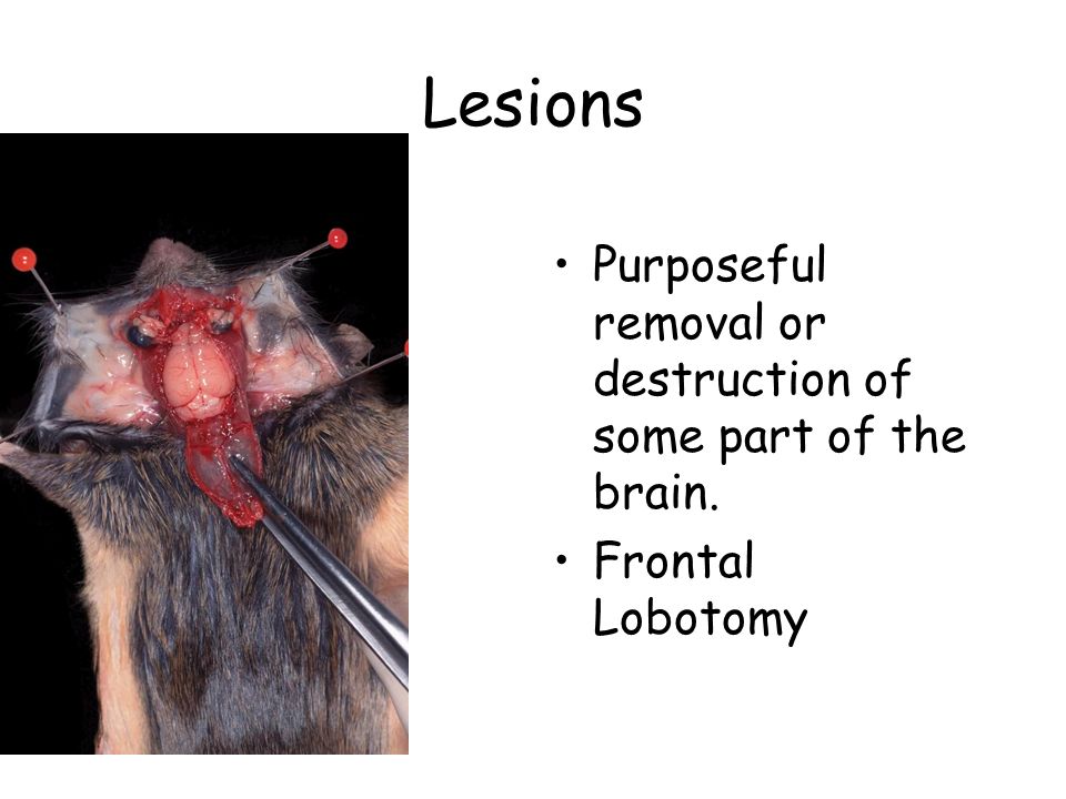 Lesions Purposeful removal or destruction of some part of the brain.
