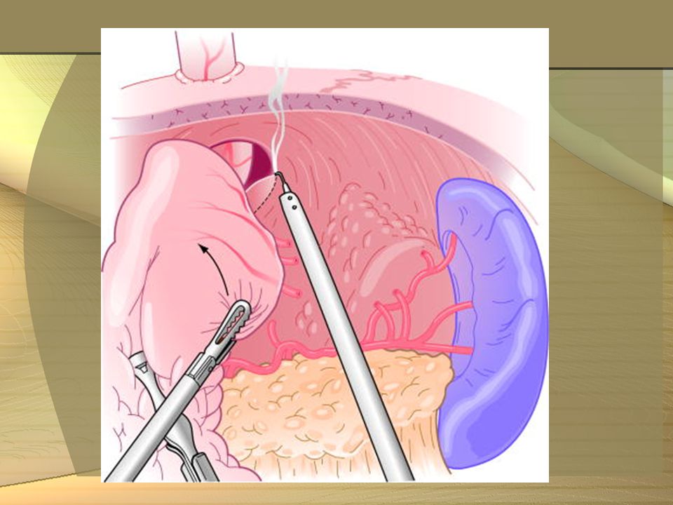 With the fundus mobilized, the phrenoesophageal membrane over the left crus may be dissected until the crural fibers are identified.